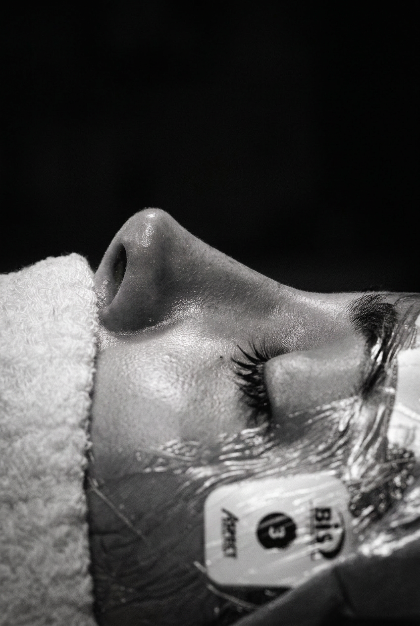 Refined nasal profile, post-op