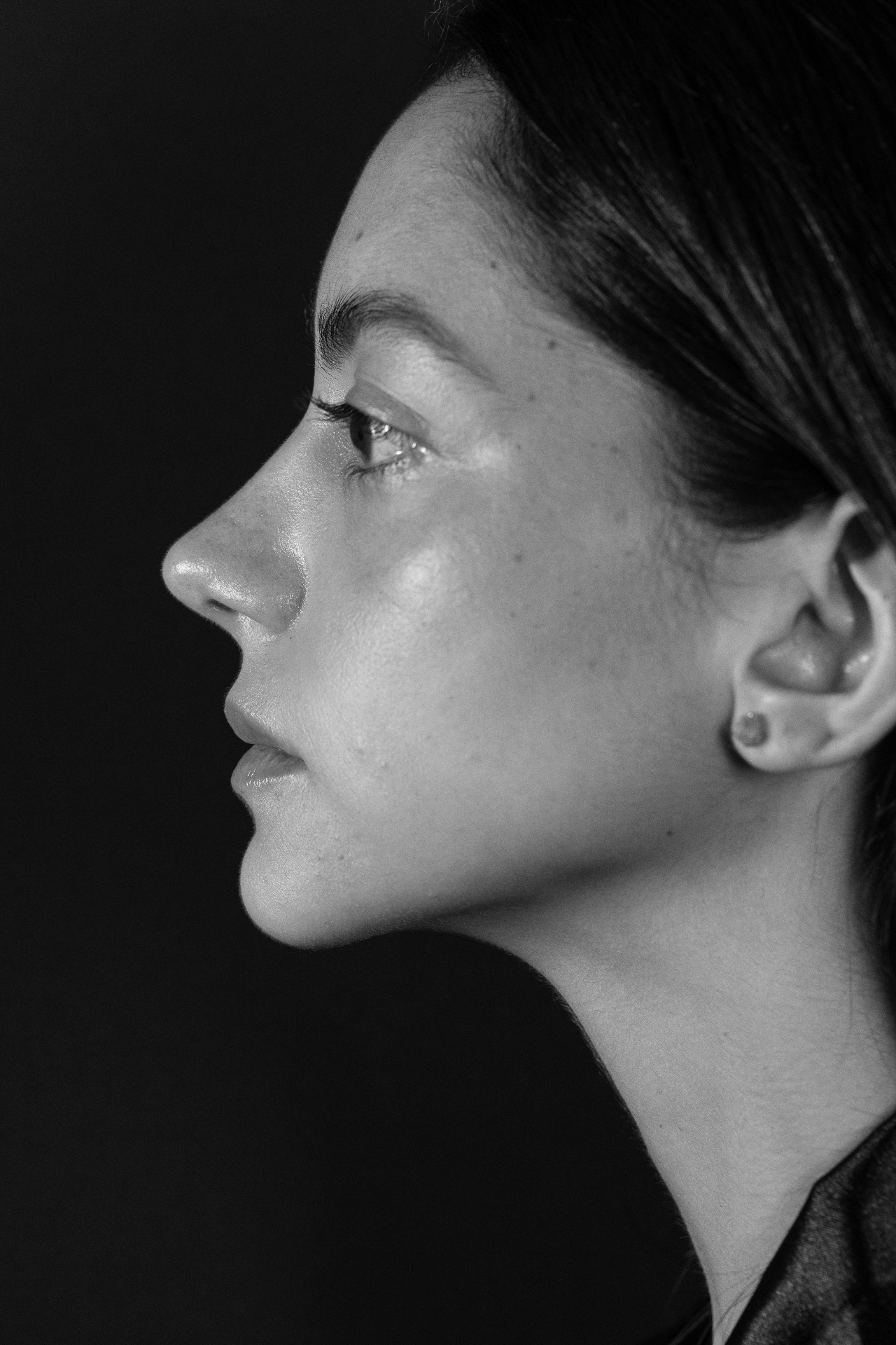 Refined nasal profile, post-op